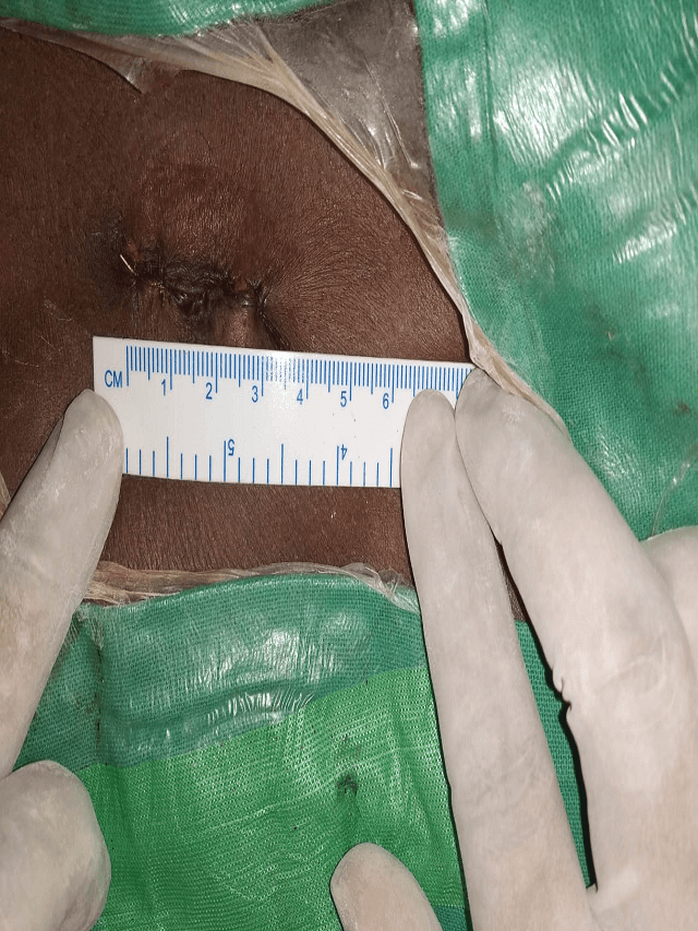 microscopic slipped disc surgery