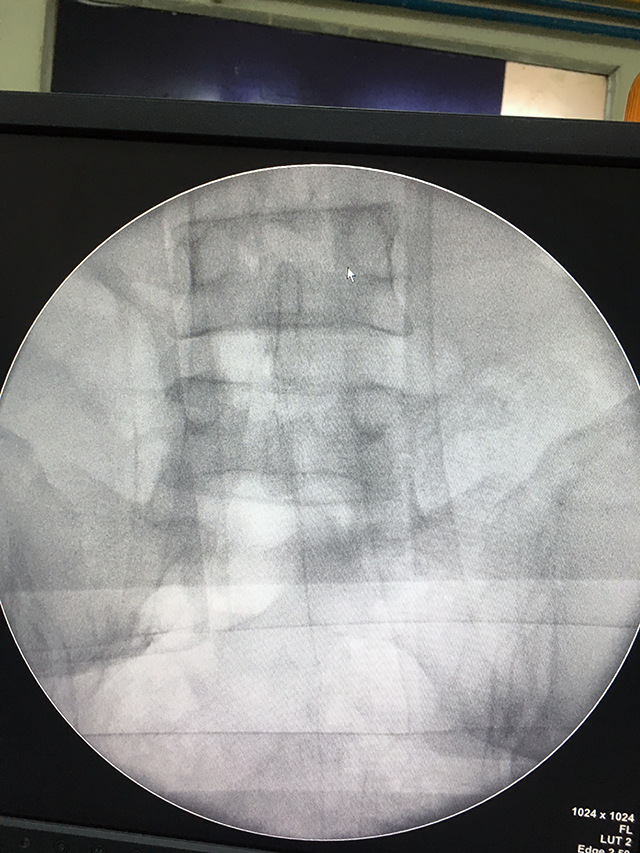 Post-op Xray - Shyamal